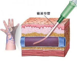 图8. 静脉注射示意